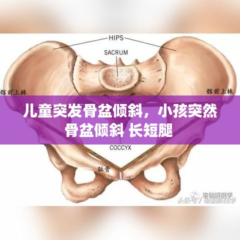 兒童突發(fā)骨盆傾斜，小孩突然骨盆傾斜 長(zhǎng)短腿 