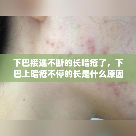 下巴接連不斷的長暗瘡了，下巴上暗瘡不停的長是什么原因 