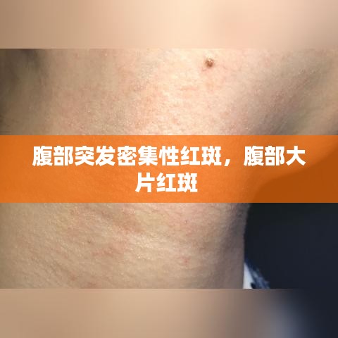 腹部突發(fā)密集性紅斑，腹部大片紅斑 